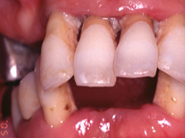 重度歯周病の歯の写真