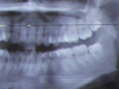 歯のレントゲン写真